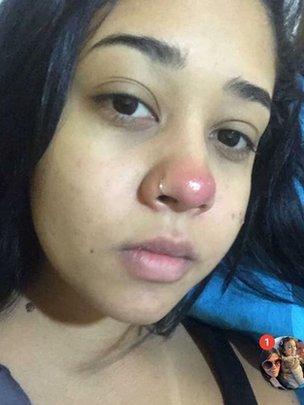 Un piercing en la nariz la condenó a una silla de ruedas de por vida 1