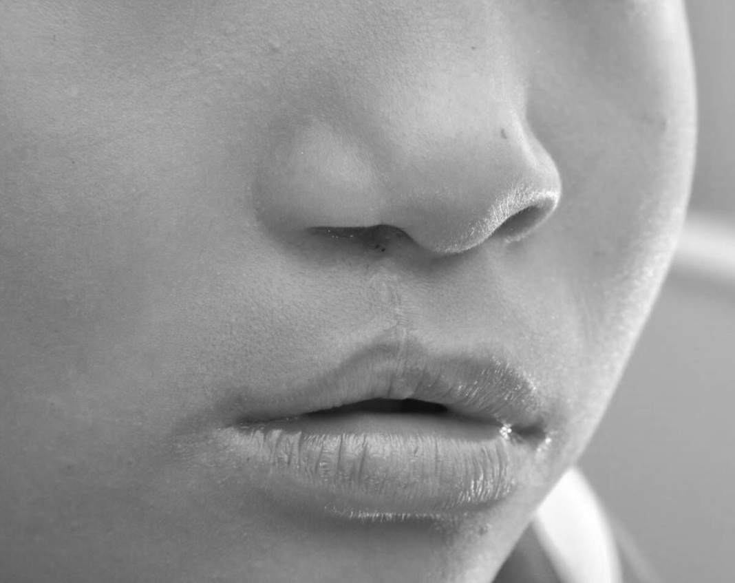 Lanza DIF campaña de cirugías gratuitas de labio y paladar hendido